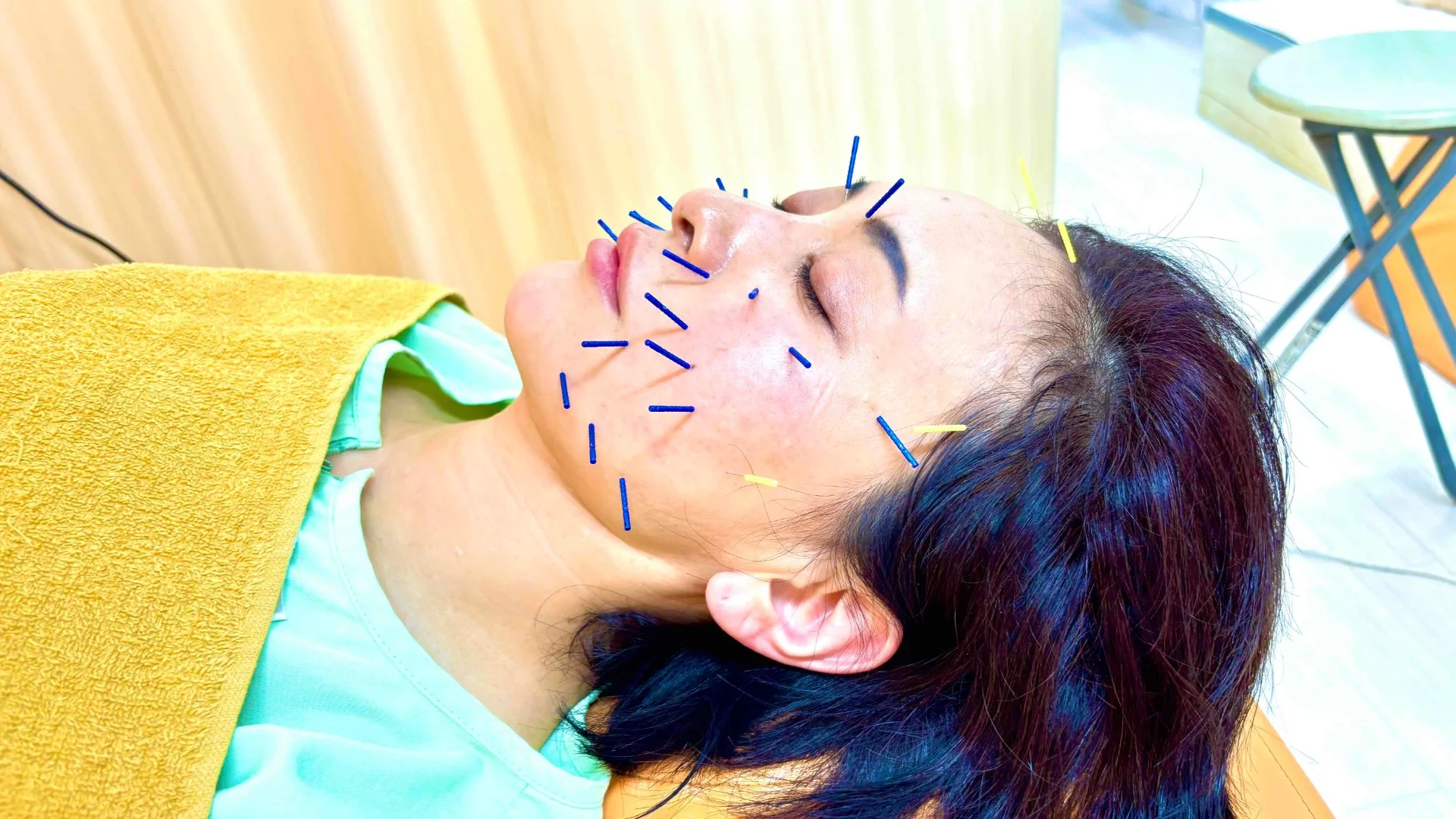 美容鍼施術の様子