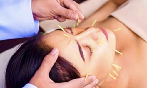 美容鍼の効果
