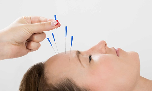 美容鍼の効果