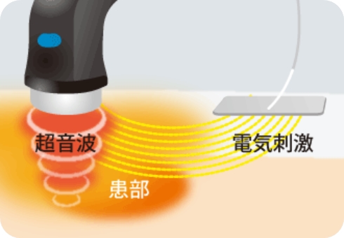 超音波高周波電気コンビネーション療法